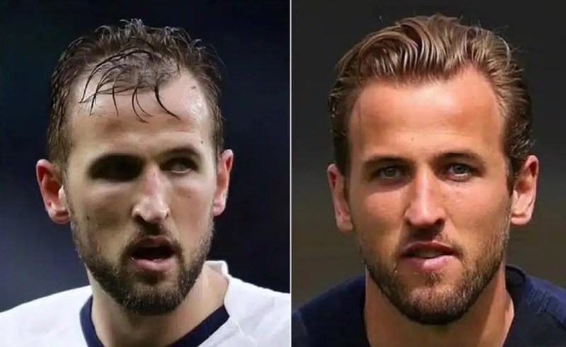 Η μεταμόσχευση μαλλιών του Χάρι Κέιν