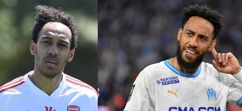 Η μεταμόσχευση μαλλιών του Πιερ Έμερικ Ομπαμεγιάνγκ