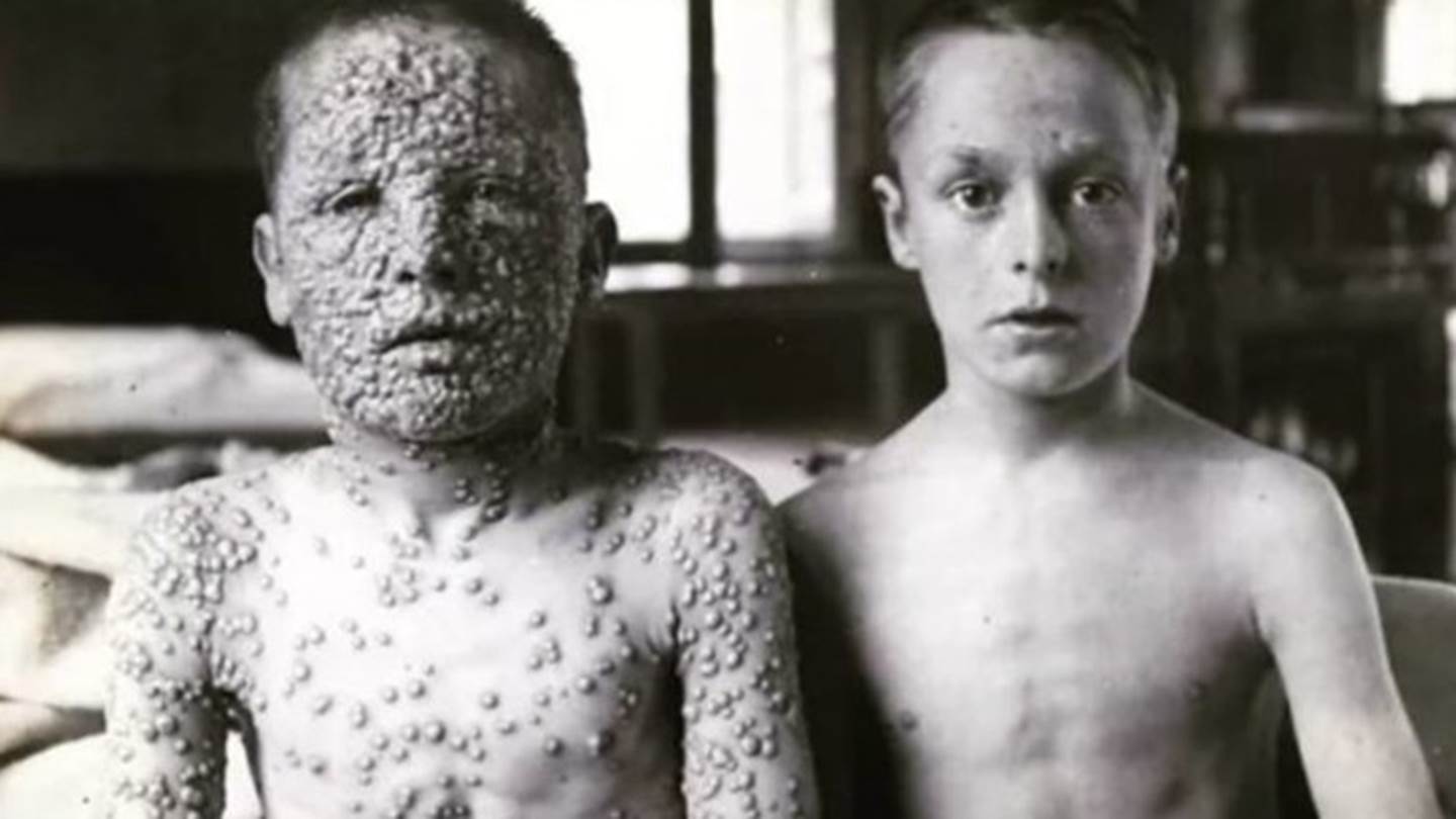 Πώς τα εμβόλια εξόντωσαν την ευλογιά και όχι μόνο