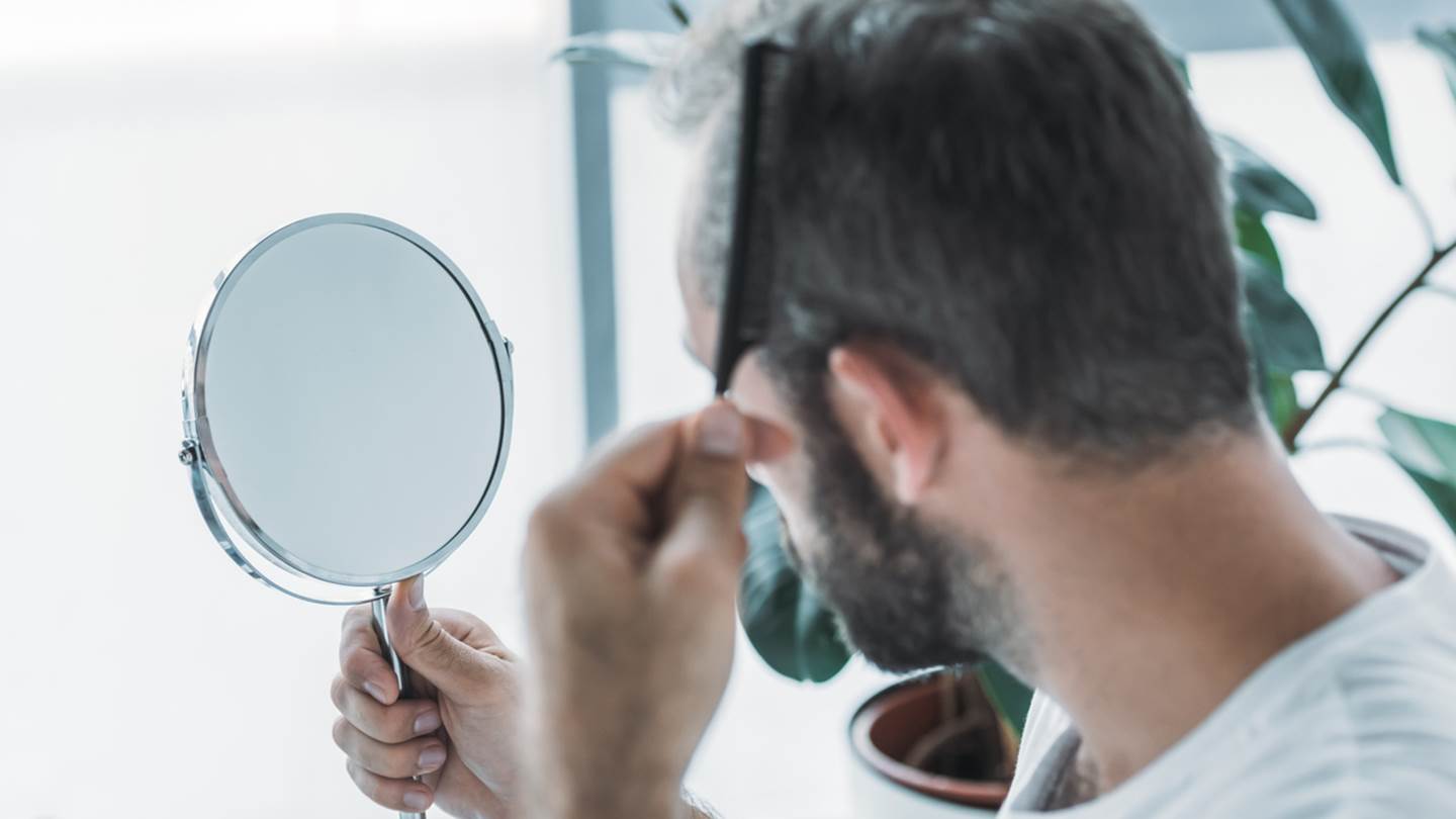 Όλη η αλήθεια για τη μεταμόσχευση μαλλιών