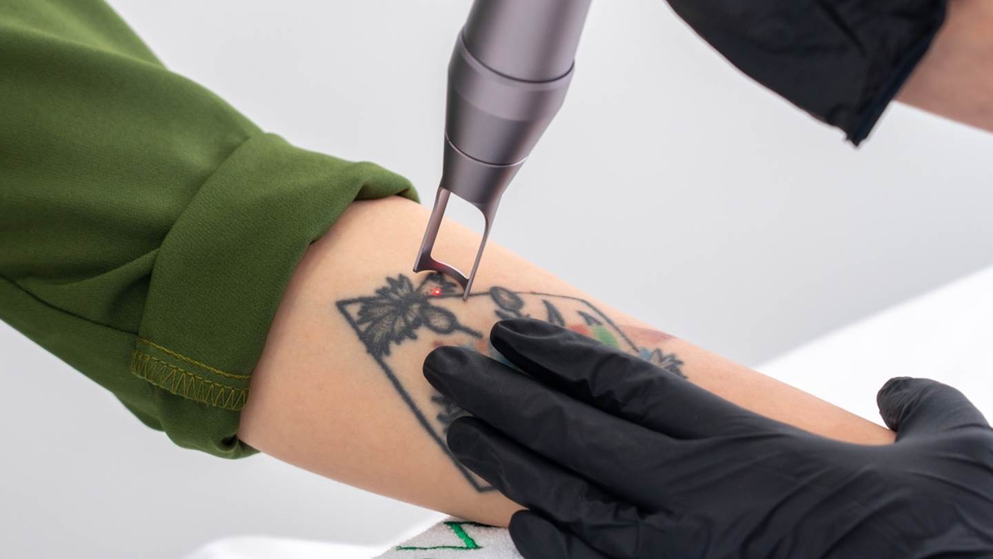 Όλα όσα πρέπει να γνωρίζεις προτού αφαιρέσεις ένα τατουάζ
