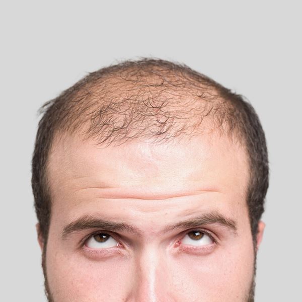 Η θεραπεία για να αντιμετωπίσεις αποτελεσματικά την αραίωση και την τριχόπτωση