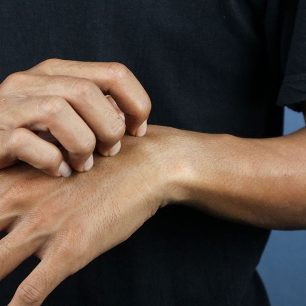 Τα κουνούπια σε τσιμπάνε γιατί είσαι 'γλυκοαίματος' - Τι λέει η επιστήμη, όμως;